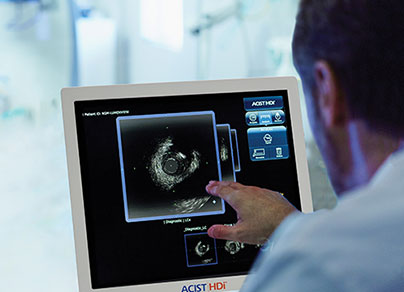 血管内超音波ガイド下PCI | HDi カテーテルシステム|アシスト